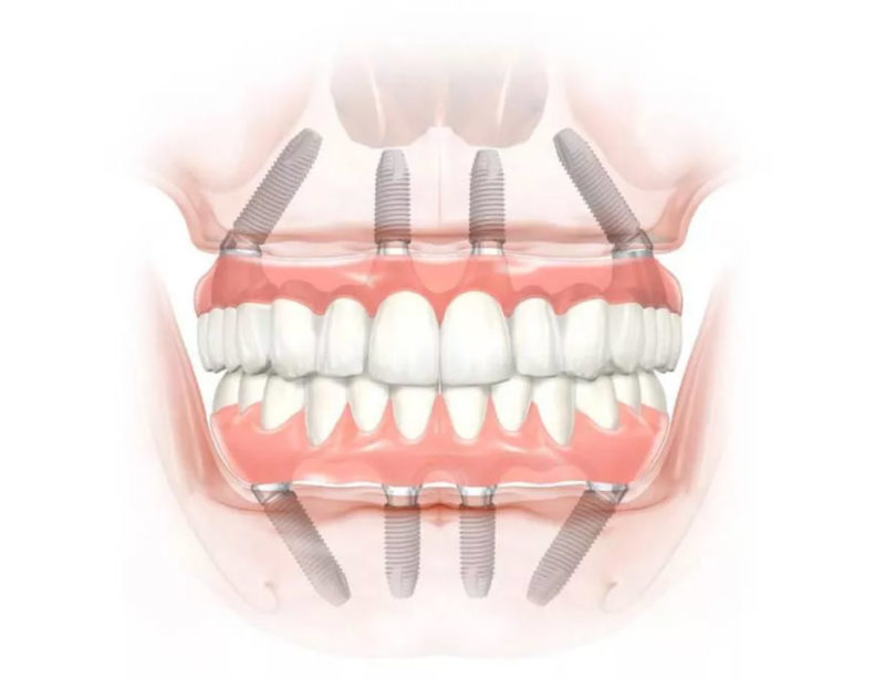 All on 4 implantátumos fogpótlás